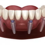 Революция в имплантации зубов: решение All-On-4