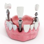 Понимание стоимости зубных имплантатов